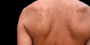 Tinea versicolor