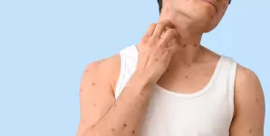 Baiat care scarpina eruptiile de varicela
