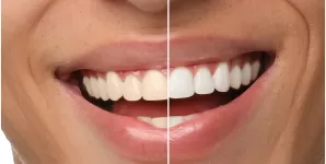 Comparatie intre dinti ingalbeniti si dinti albi, prim-plan cu zambet