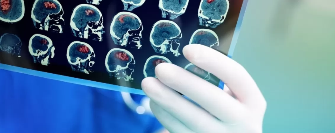 anevrismul vascular cerebral