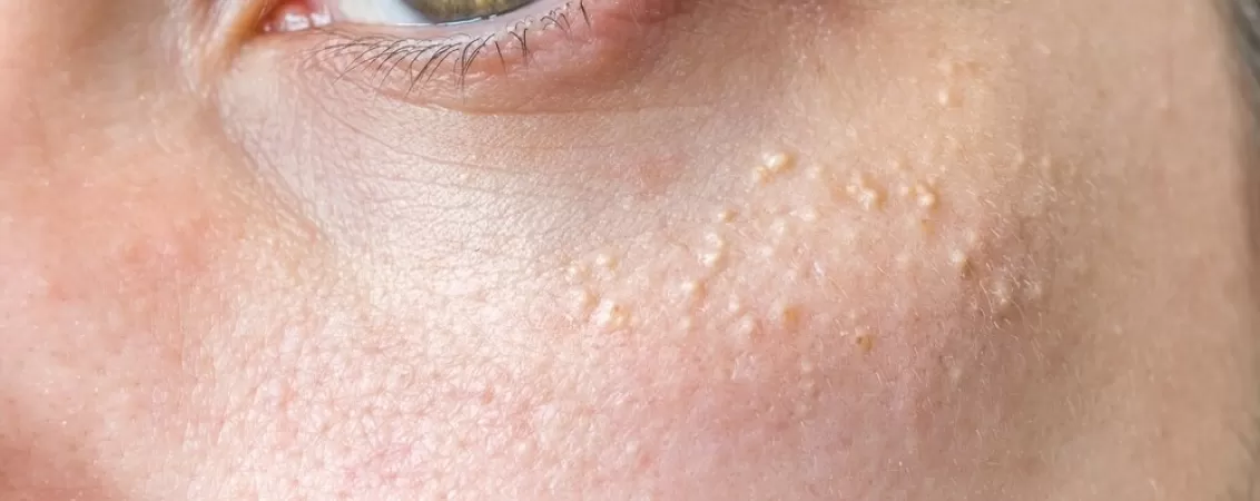 milia puncte de grasime cauze simptome tratament