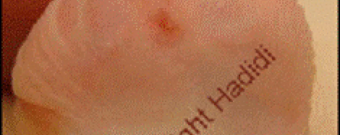 tratament chirurgical pentru hipospadias ce trebuie sa stii