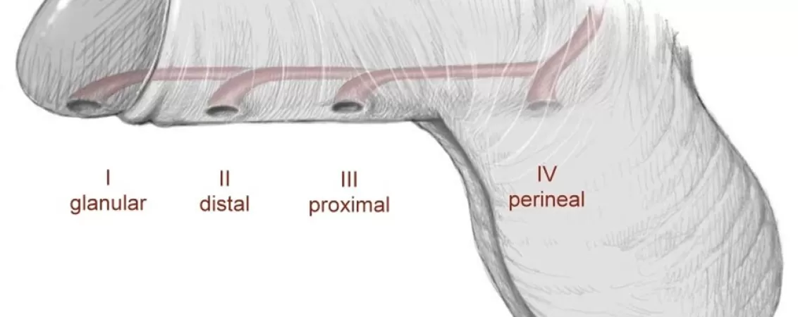 tratament chirurgical pentru hipospadias ce trebuie sa stii