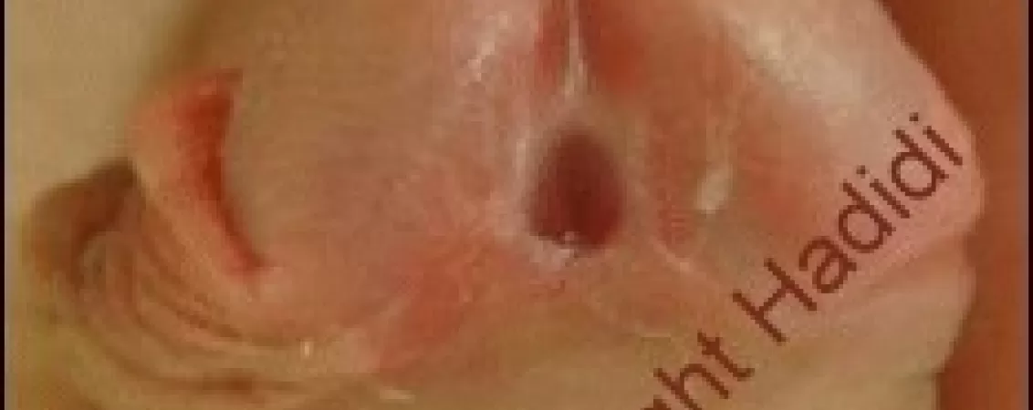 tratament chirurgical pentru hipospadias ce trebuie sa stii