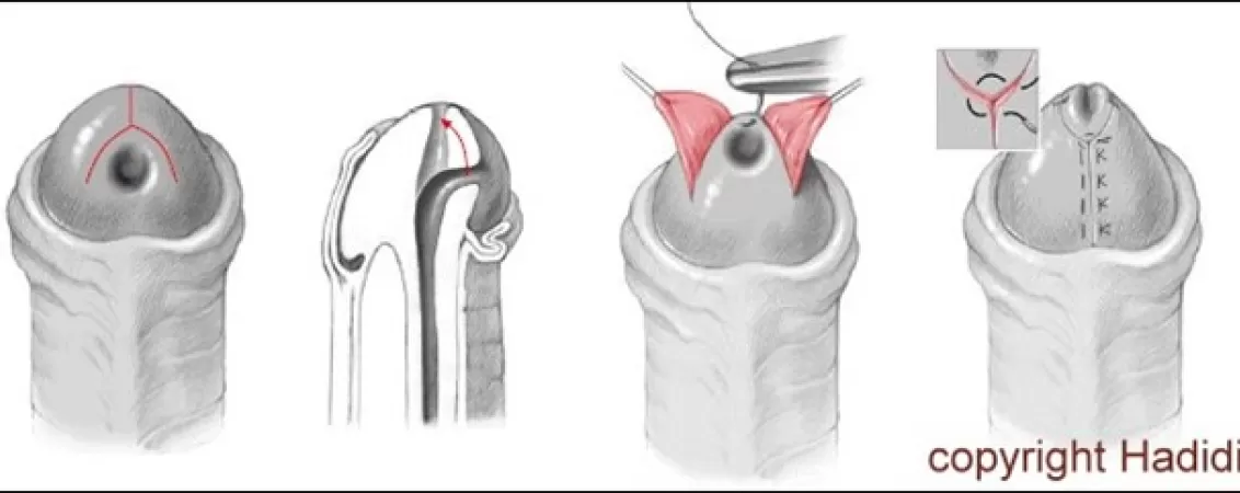 tratament chirurgical pentru hipospadias ce trebuie sa stii