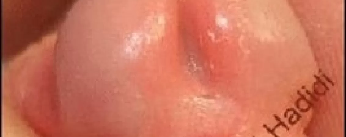 tratament chirurgical pentru hipospadias ce trebuie sa stii