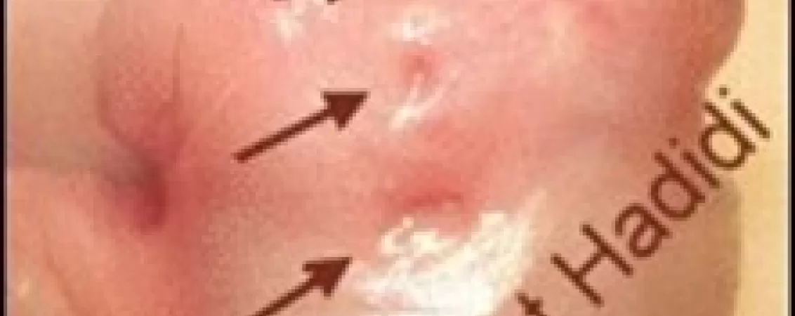 tratament chirurgical pentru hipospadias ce trebuie sa stii