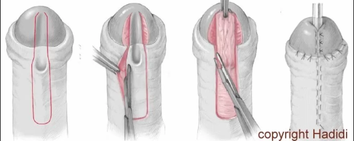 tratament chirurgical pentru hipospadias ce trebuie sa stii