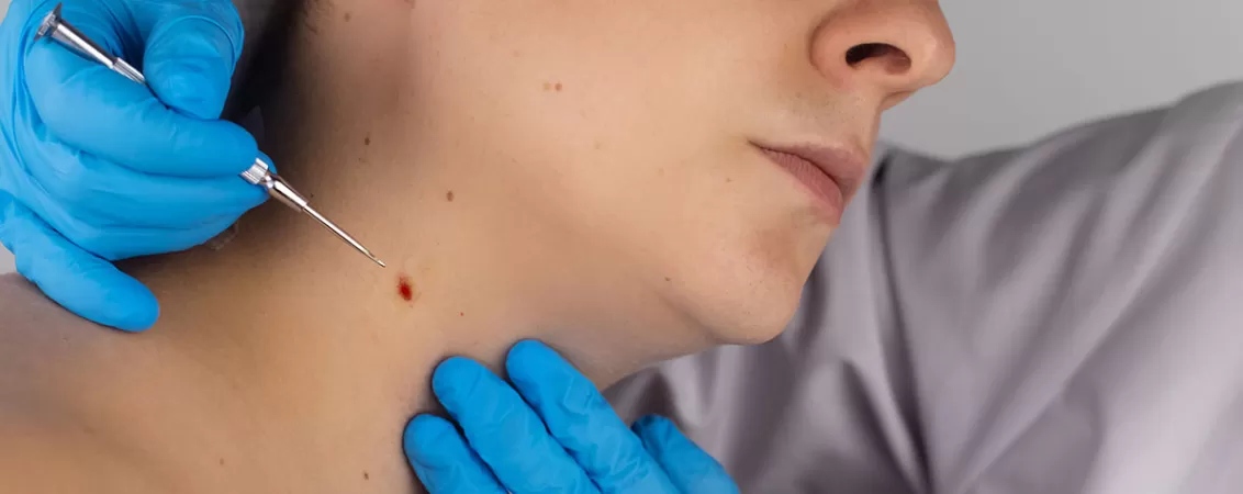 Prim-plan al unei rani ramase dupa excizia unui nev