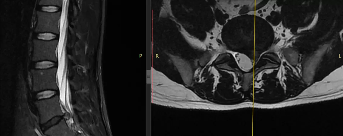 Radiografie spinala efectuata inainte de endoscopia monoportala