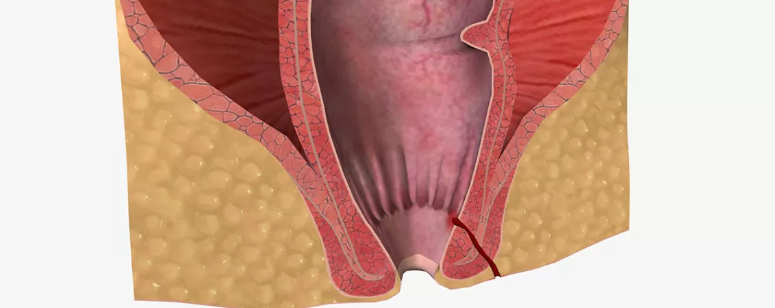 Ilustrație 3D exemplificând o fistulă anală