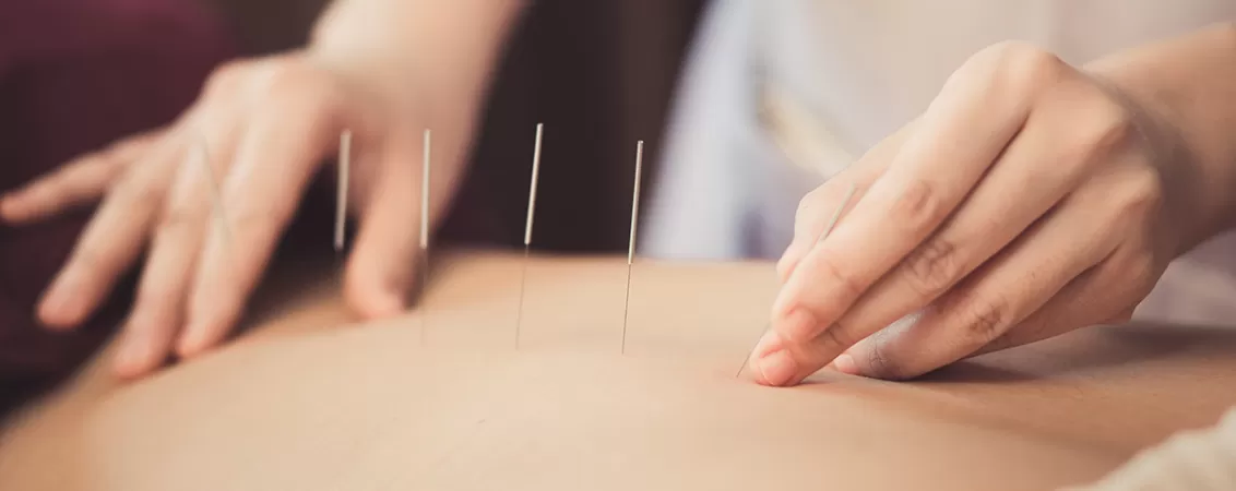 Prim-plan cu un terapeut care inserează ace fine de acupunctură în timpul tratamentului