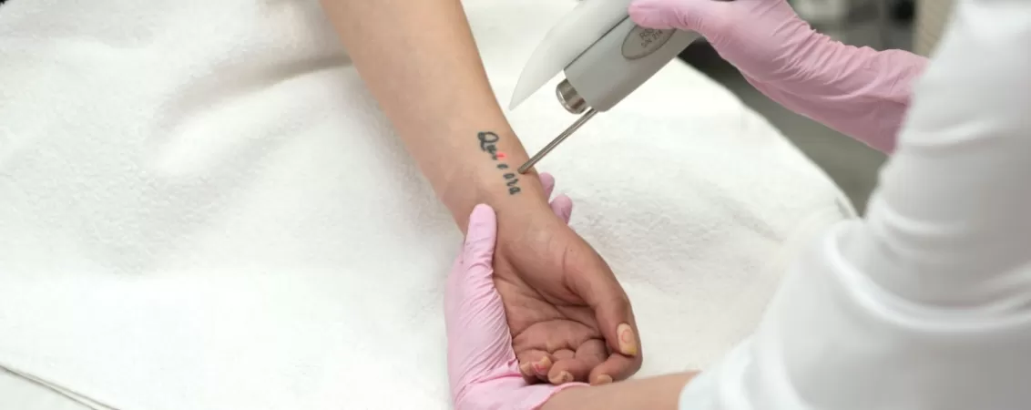 Procedura de indepartare a tatuajului cu laser efectuata de un medic dermatolog