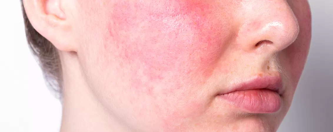 Femeie cu fața roșie, suferind de rozacee (cuperoză)