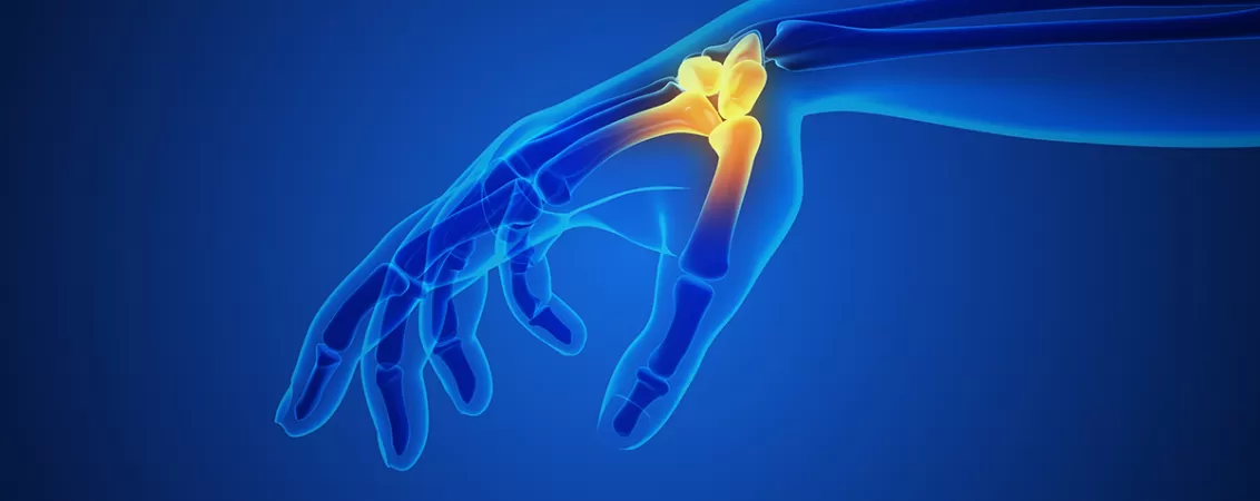 Ilustratie 3D a artritei la deget si articulatia policelui (degetului mare)