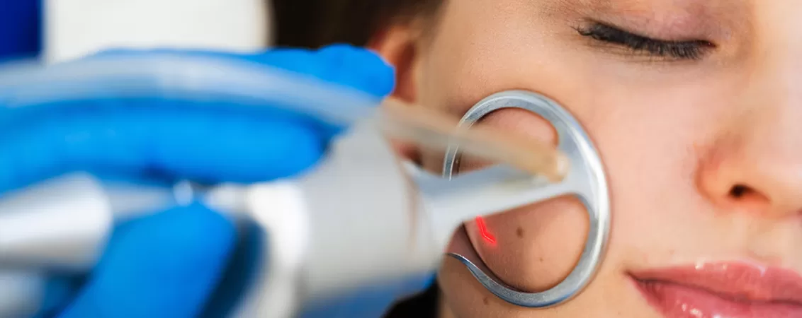 Tratament cu laser CO2 aplicat la nivelul fetei
