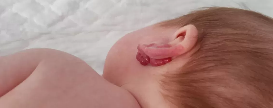 Hemangiom infantil in spatele urechii