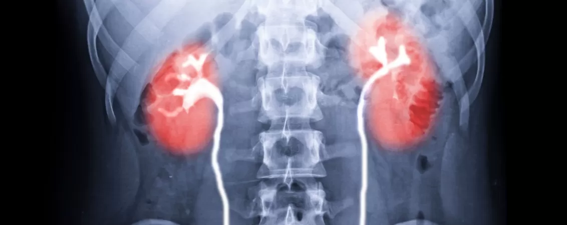 Radiografie intravenoasa pyelograma pentru examinarea tractului urinar