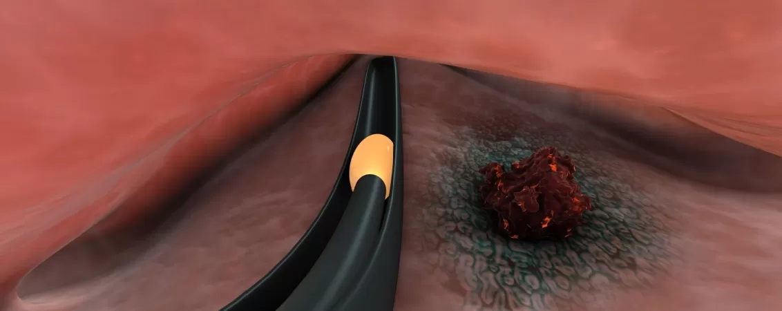Ilustratie 3D brahiterapie (radioterapie interna) pentru cancer cervical.