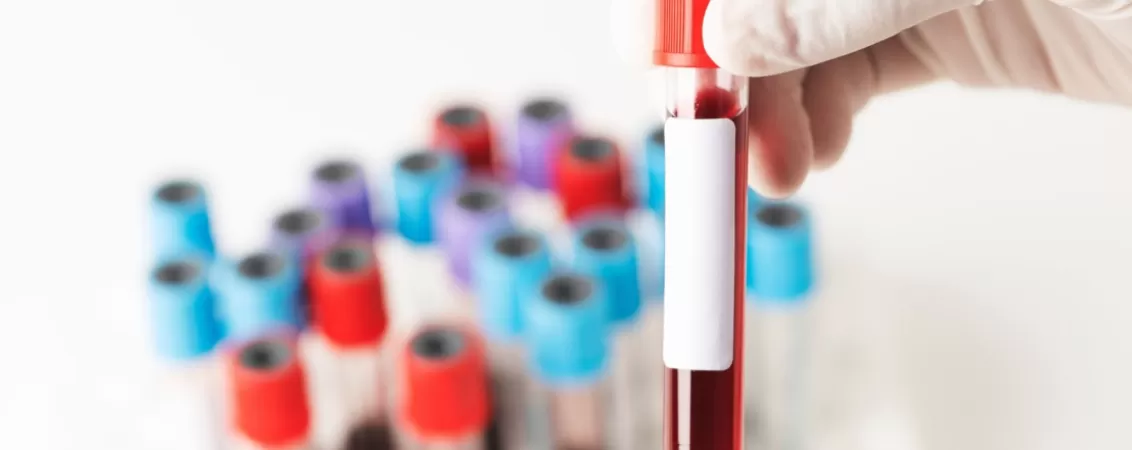 Mana cu manusa tinand o proba de sange pentru analize