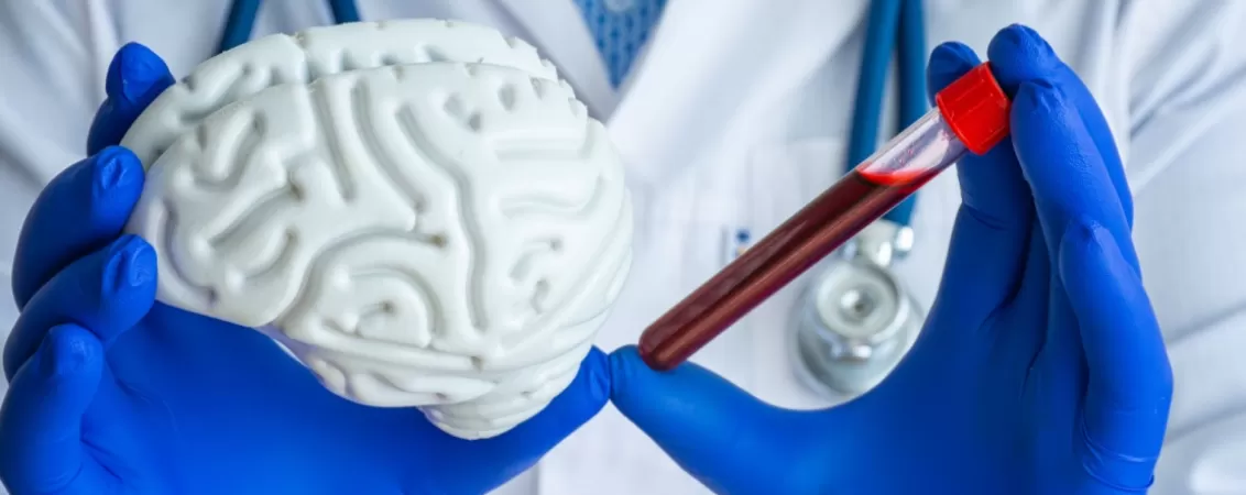 Medic tinand in maini un model al creierului si o mostra de sange pentru analize