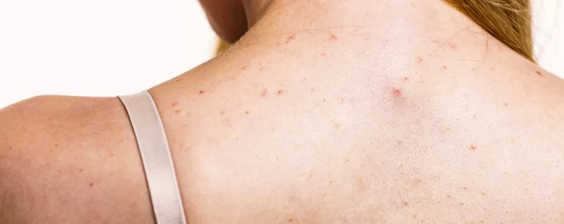 Spatele unei femei care sufera de probleme asociate cu aparitia petelor rosii pe piele