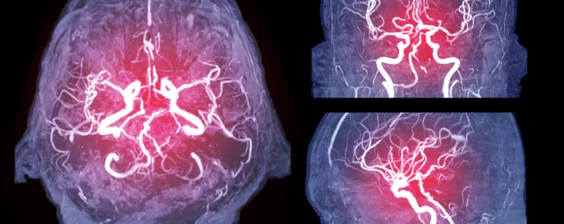 Colectie de imagini Angio RMN cerebral