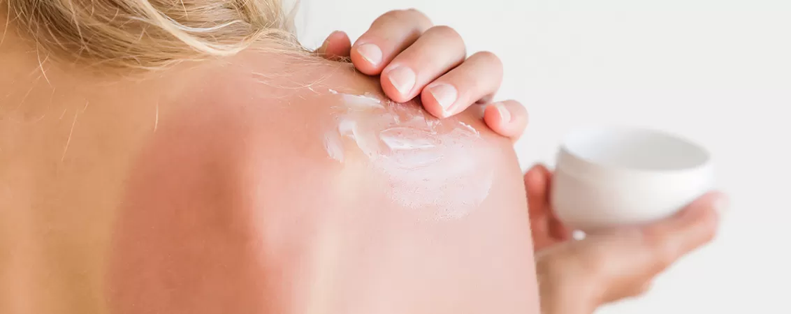 Femeie ce aplica o crema cu benzocaina pe spatele ars de soare