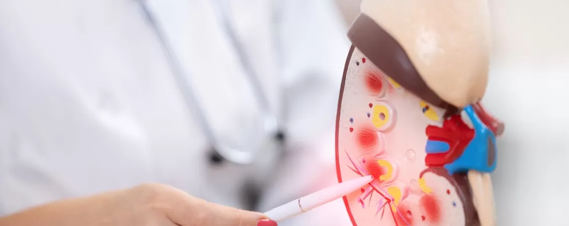 Medic care arata pietre renale pe un mulaj