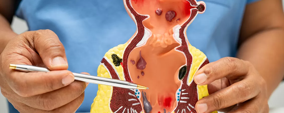 Medic asiatic explica anatomia rectului si hemoroizilor, prezentand detalii despre cauze, simptome si ingrijire medicala
