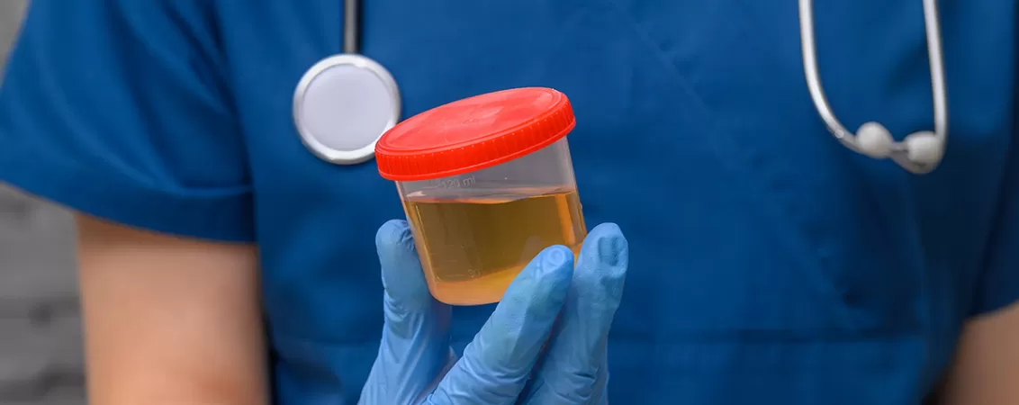 Medic care tine un recipient din plastic cu proba de urina a unui pacient, pregatit pentru investigatii si teste medicale