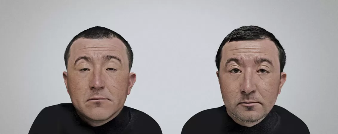 Pacientul inainte si dupa interventia chirurgicala pentru sindrom BPES