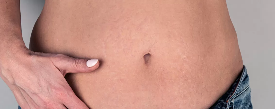Abdomen femeie dupa nastere, inainte de remodelare corporala