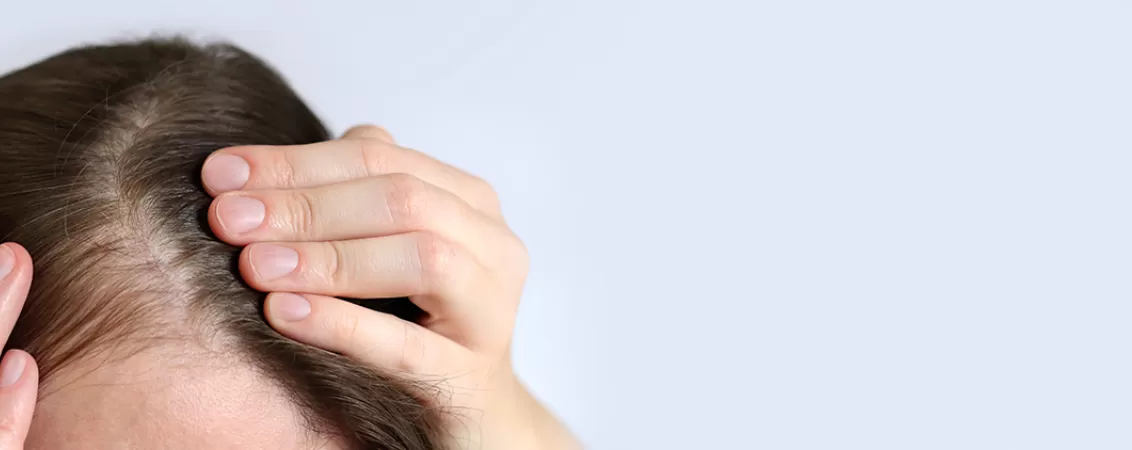 Caderea parului la femei, posibil semn de deficit de androgeni