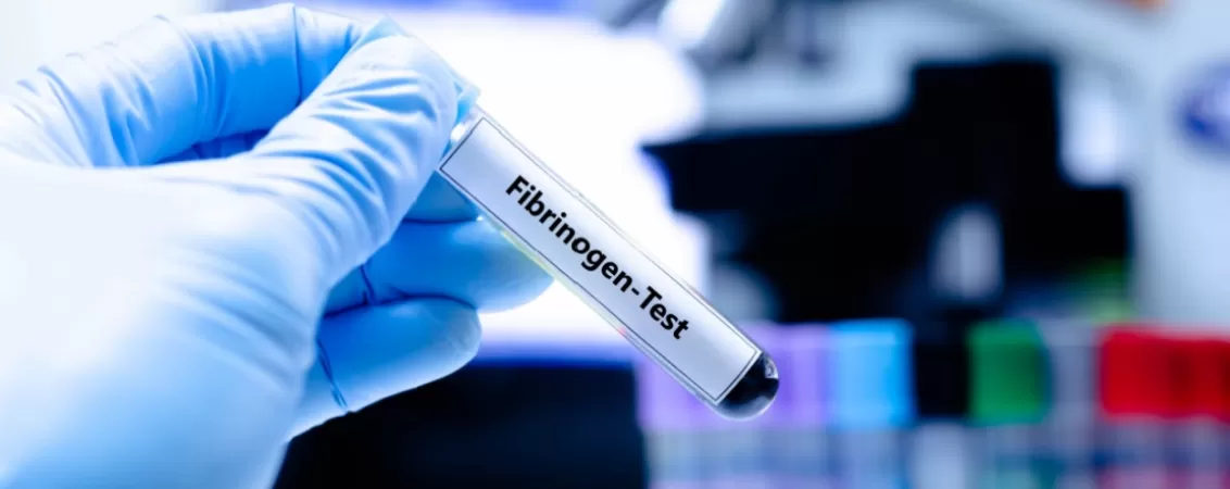 Eprubeta cu proba de sange pentru analiza fibrinogenului, utilizata in laborator pentru evaluarea coagularii si identificarea riscurilor cardiovasculare
