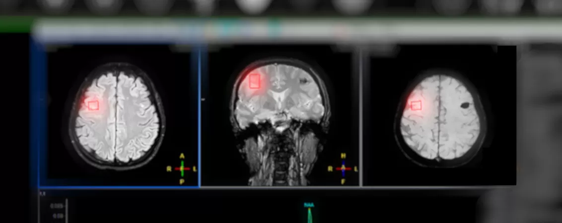 Spectroscopie RM pentru AVC.