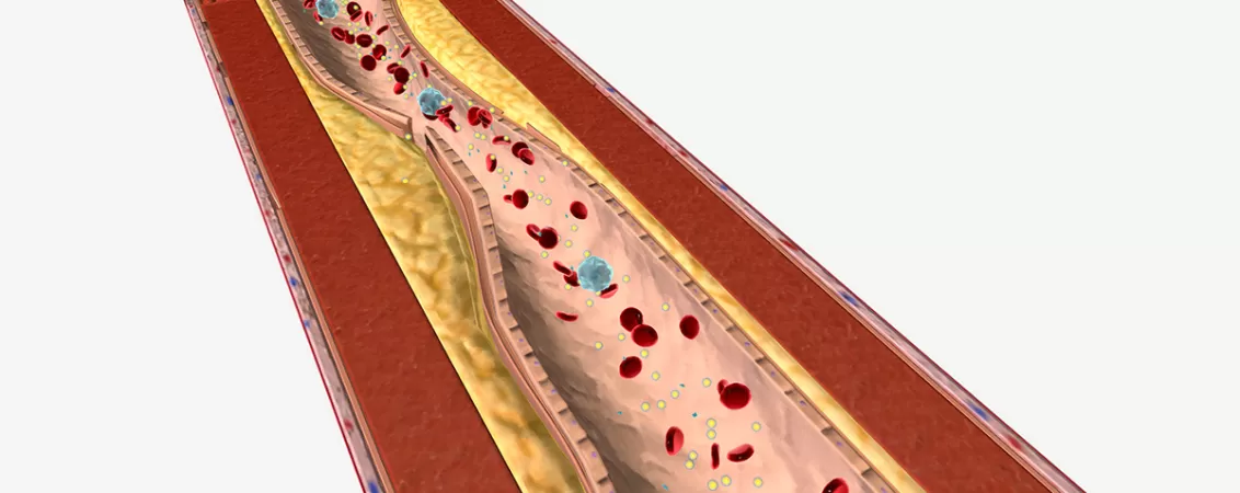 Ilustratie medicala care prezinta hipertrigliceridemia, afectiune caracterizata prin niveluri crescute de trigliceride in sange.