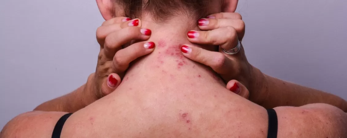 Spate pacienta cu dermatita atopica