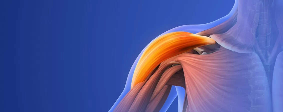 Ilustratie a unei leziuni la umar care provoaca durere musculara