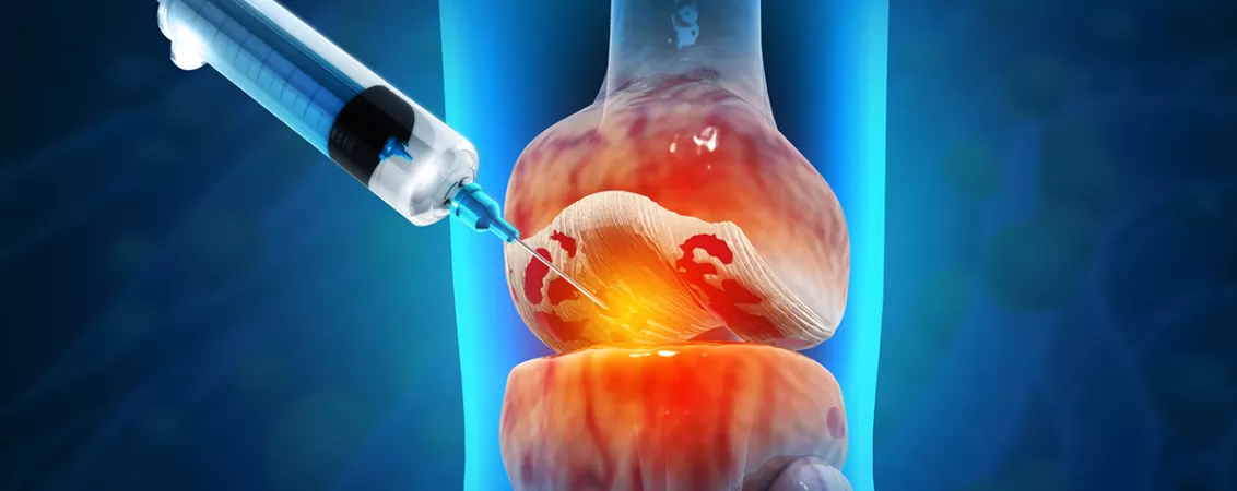 Ilustratie injectii cu acid hialuronic in genunchi pentru gonartroza