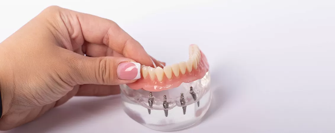 Implant dentar Fast&Fixed pe arcada mandibulara