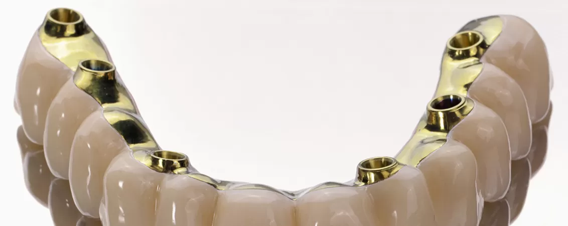 Implant dentar Fast&Fixed pe arcada maxilara