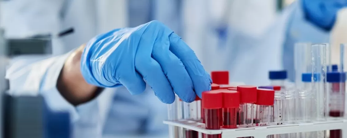 Mana tinand o proba de sange pentru analiza medicala in laborator