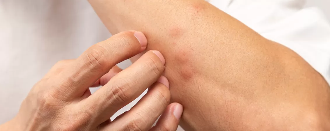 Bratul unui barbat cu intepaturi de insecte