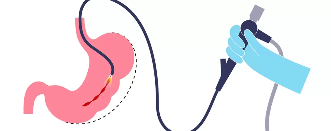 Ilustrare a conceptului de gastric sleeve endoscopic.