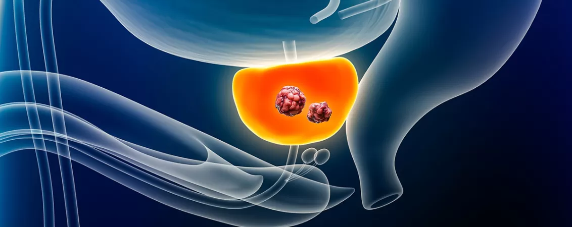 Ilustrație 3D reprezentând cancerul de prostată.