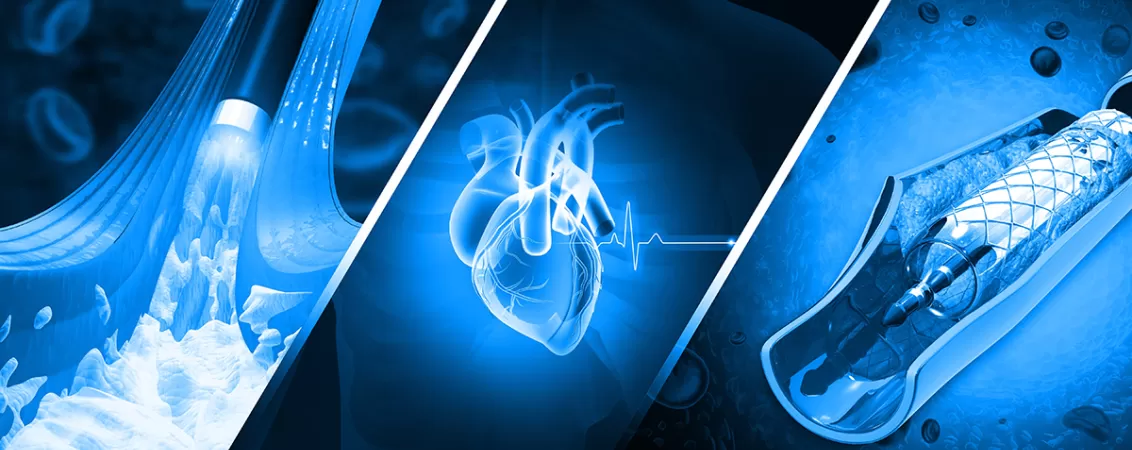 Ilustratie artere afectate de ateroscleroza si angioplastie cu stent