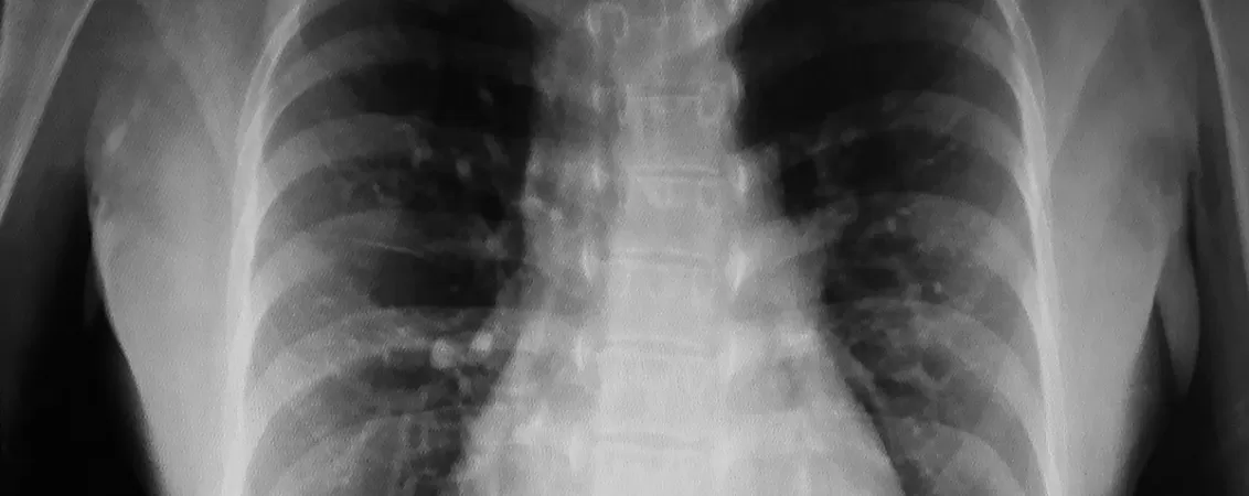 Imagine a unei radiografii la plamani