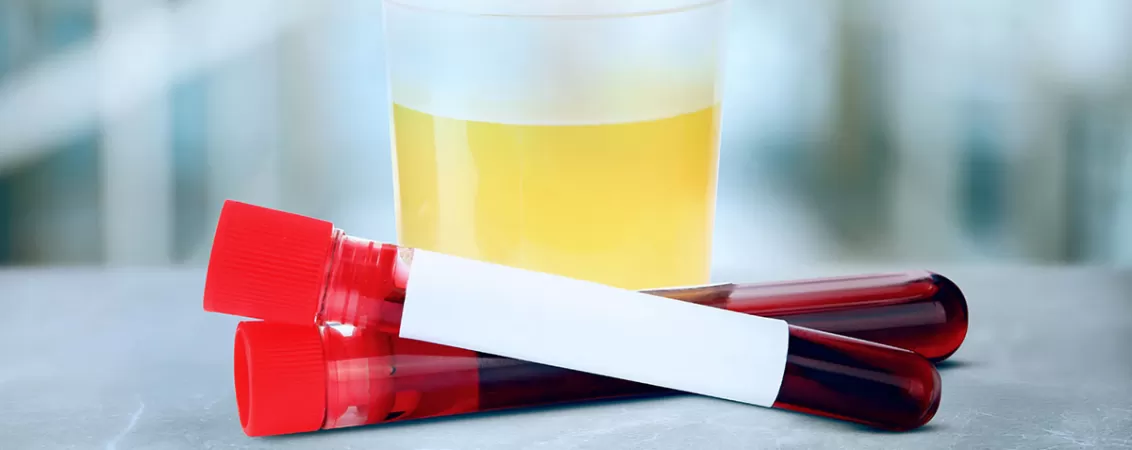 Probe de sange si urina pentru analize in vederea diagnosticarii bolii cronice de rinichi