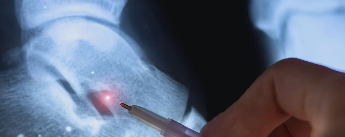 Radiografie care evidentiaza o fractura la nivelul peroneului